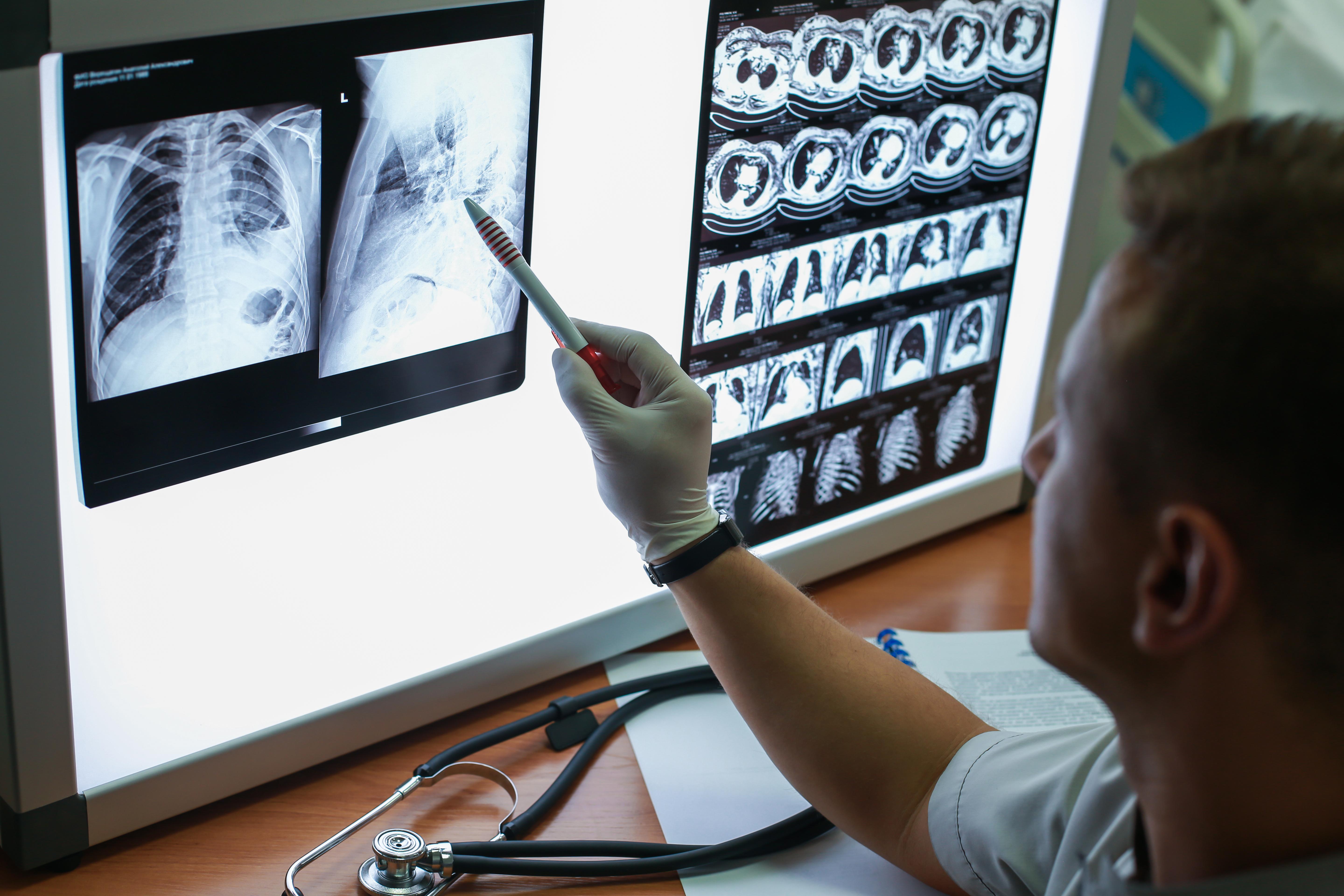 A healthcare provider examines a chest x-ray to look for signs of COPD or other problems with the lungs. 