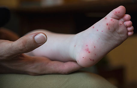 Hand, Foot, & Mouth Disease