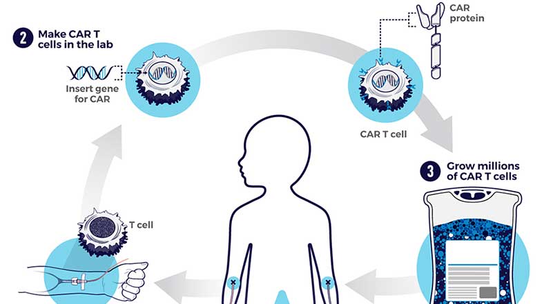 This schematic shows the steps for creating CAR T-cell therapy, a type of treatment in which a patient's T cells (a type of immune system cell) are changed in the laboratory so they will attack cancer cells. 