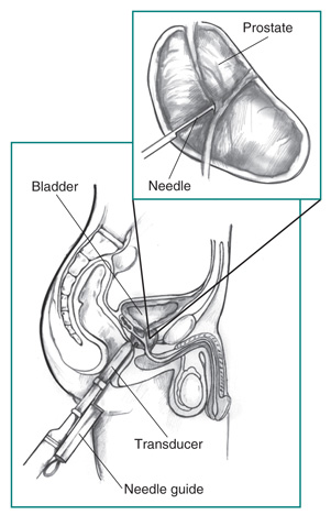 Drawing of a transrectal ultrasound with prostate biopsy, showing a needle and needle guide inserted in the rectum. The bladder, transducer, and needle guide are labeled. Inset of enlarged view of prostate with needle inserted. The prostate and needle are labeled.