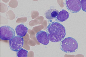 Lymphoblasts from an ALL patient stained in blue