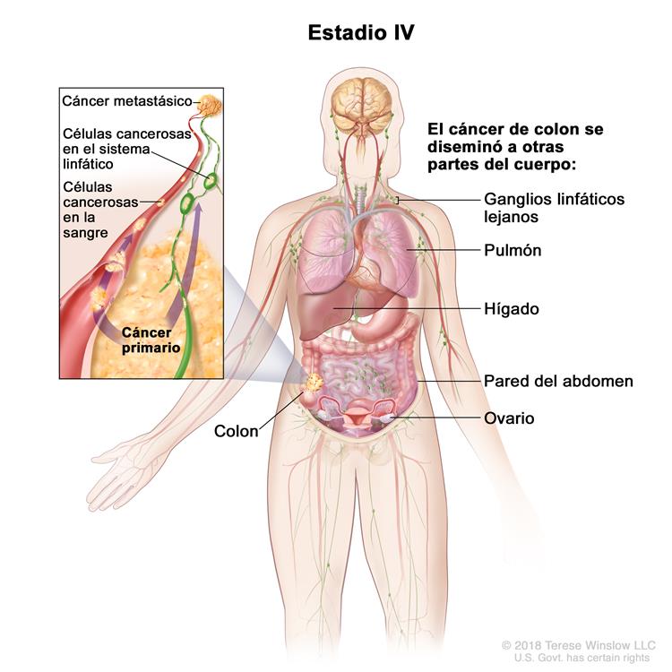 Cáncer de colon en estadio IV. En la imagen se muestran otras partes del cuerpo donde es posible que el cáncer de colon se disemine, como los ganglios linfáticos lejanos, el pulmón, el hígado, la pared del abdomen y el ovario. En el recuadro se muestran las células cancerosas que se diseminan desde el colon a través de la sangre y el sistema linfático hasta otra parte del cuerpo donde se formó el cáncer metastásico.