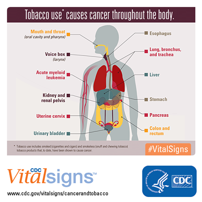 Tobacco use causes cancer throughout the body: Mouth and throat, oral cavity and pharynx, esophagus, voice box, larynx, lung, bronchus, and trachea, acute myeloid leukemia, liver, kidney and renal pelvis, stomach, uterine cervix, pancreas, colon and rectum, and urinary bladder. Tobacco use includes smoked (cigarettes and cigars) and smokeless (snuff and chewing tobacco) tobacco products that have been shown to cause cancer.