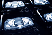 More men with low-risk prostate cancer are forgoing aggressive treatment - 