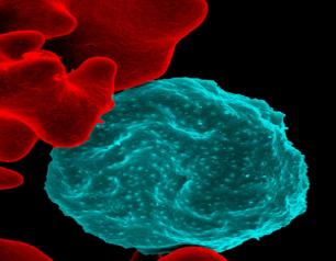 A red blood cell infected with malaria parasites.
