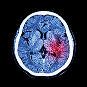 Neuroprotective compound may improve brain function after stroke - ©Stock/stockdevil