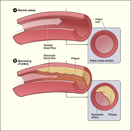 Atherosclerosis diagram.