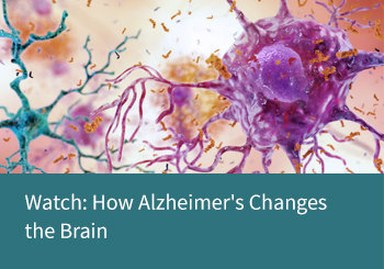 Watch: How Alzheimer's Changes the Brain