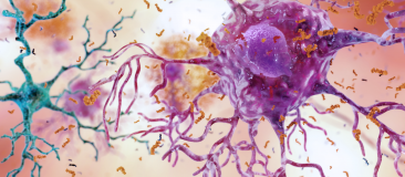 Brain inflammation – microglia fail to clear debris, astrocytes react 