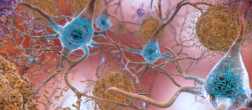 Beta-amyloid plaques and tau in the brain 