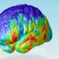 Brain showing Alzheimer's pathology