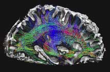 New high-resolution, non-invasive imaging techniques produce detailed diagrams of neural tracts, enabling new analyses of how
brain regions are connected. Credit: Washington University – University of Minnesota Human Connectome Project consortium