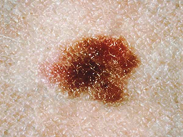 This dysplastic nevus is more than 10 millimeters wide (a little less than 1/2 inch). 