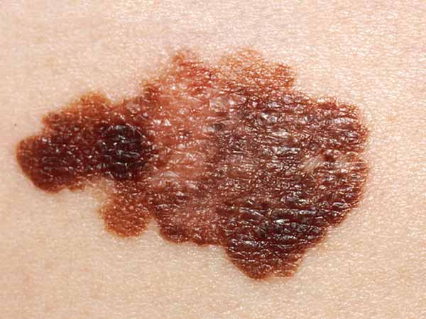 An uneven (asymmetric) melanoma with an irregular but distinct border. The melanoma is more than 20 millimeters wide (about the size of a postage stamp).