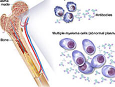 Illustration of Multiple Myeloma