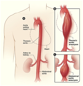 This image shows a normal aorta, and next to it shows a thoracic aortic aneurysm. It also shows an abdominal aortic aneurysm that is located below the arteries that supply blood to the kidneys.