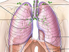 Two-panel drawing of stage I non-small cell lung cancer. First panel shows stage IA with cancer (3 cm or less) in the right lung; also shown are the right main bronchus, trachea, lymph nodes, bronchioles, and diaphragm. Second panel shows stage IB with cancer (more than 3 cm but not more than 5 cm) in the left lung and in the left main bronchus; the carina is also shown. Inset shows cancer that has spread from the lung into the innermost layer of the lung lining; a rib is also shown.