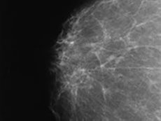 A mammogram image of a dense breast