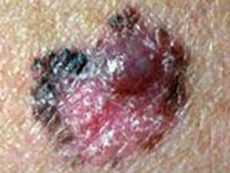 Photo of a melanoma on a person's skin