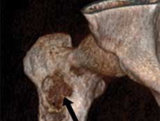 An imaging scan of an alveolar soft-part sarcoma in a femur.