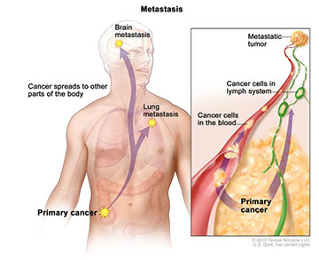 Metastasis; drawing shows primary cancer that has spread from the colon to other parts of the body (the lung and the brain). An inset shows cancer cells spreading from the primary cancer, through the blood and lymph system, to another part of the body where a metastatic tumor has formed.