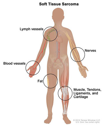 Soft tissue sarcoma; drawing shows different types of tissue in the body where soft tissue sarcomas form, including the lymph vessels, blood vessels, fat, muscles, tendons, ligaments, cartilage, and nerves.