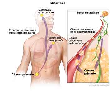 Metástasis; en la ilustración, se muestra un cáncer primario que se diseminó desde el colon hasta otras partes del cuerpo (pulmón y cerebro). En el panel, se muestran células cancerosas que se diseminan desde el cáncer primario, por medio de sistema vascular y linfático, hasta otra parte del cuerpo donde se formó un tumor metastásico.