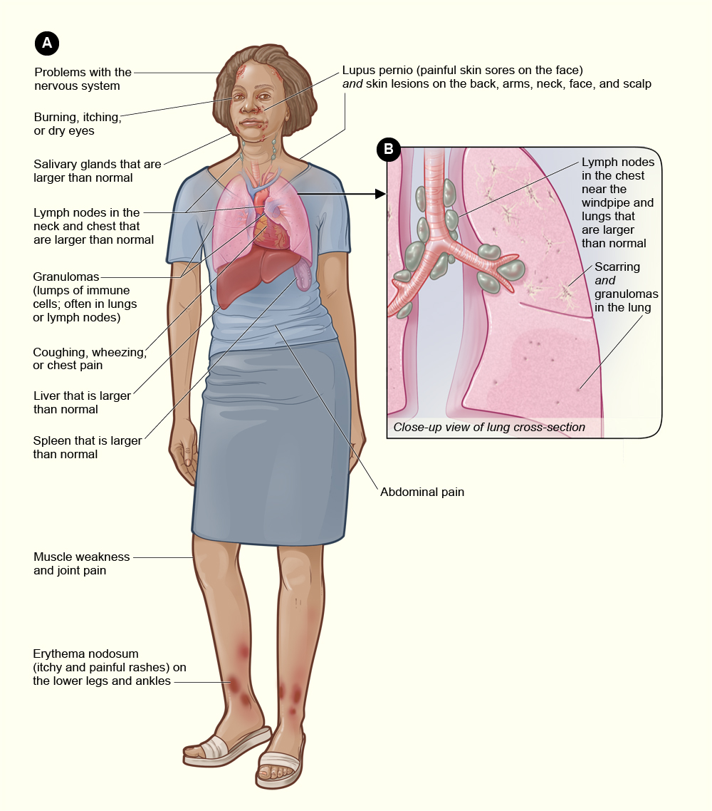The illustration shows some of the signs and symptoms of sarcoidosis and the organs involved, including problems with the nervous system; burning, itching, or dry eyes; swollen salivary glands; swollen lymph nodes in the neck and chest; and granulomas, which are lumps of immune cells often found in the lungs and lymph nodes. Other signs and symptoms in the illustration include coughing, wheezing, or chest pain; a liver that is larger than normal, spleen that is larger than normal; abdominal pain; muscle weakness and joint pain; erythema nodosum; lupus pernio; and skin lesions on the back, arms, neck, face, and scalp. On a close-up view of a cross-section of the lung, the illustration shows swollen lymph nodes in the chest, near the windpipe and lungs; and scarring and granulomas in the lung. 