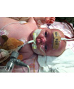 Image three - Infant being treated for severe pertussis infection