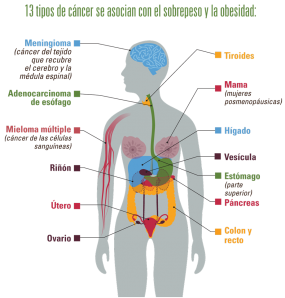 Infografía: 13 tipos de cáncer se asocian con el sobrepeso y la obesidad. Estos son: meningioma (cáncer del tejido que recubre el cerebro y la médula espinal), adenocarcinoma de esófago, mieloma múltiple (cáncer de las células sanguíneas), riñón, útero, ovario, tiroide, mama (mujeres posmenopáusicas), hígado, vesícula, estómago (parte superior), páncreas, y colon and recto
