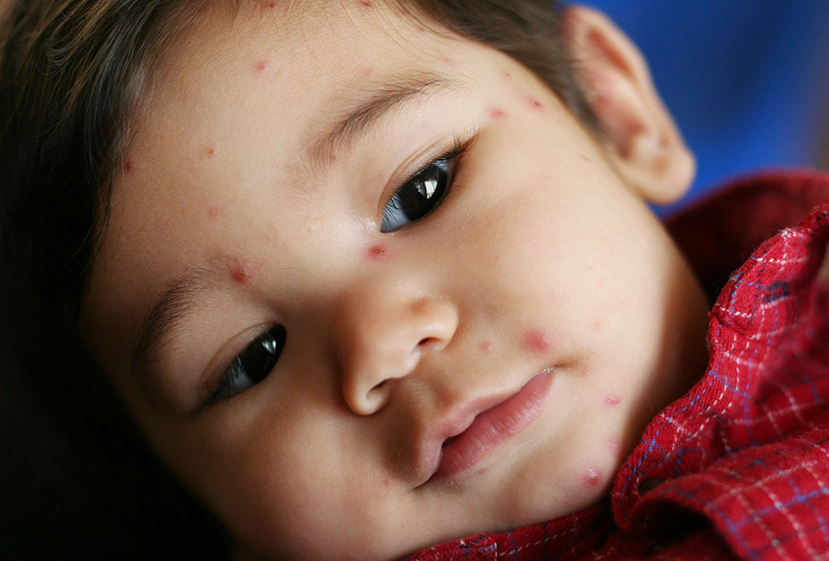 Boy with chickenpox and fever