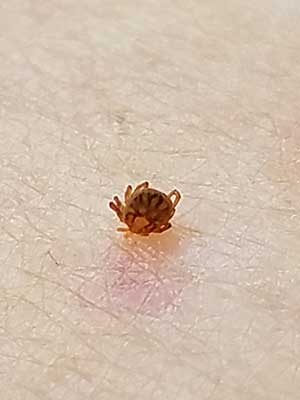 Nymphal lone star tick attached to a person. 
