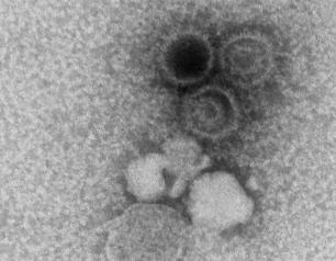 An electron microscopy image showing three Epstein-Barr virions. 