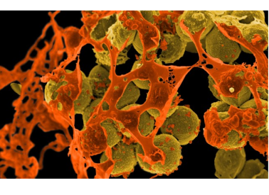 Scanning electron micrograph of methicillin-resistant Staphylococcus aureus (MRSA) in brown surrounded by cellular debris in orange.