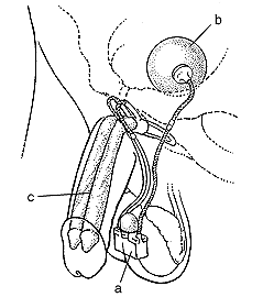 Ilustracin de un implante inflador