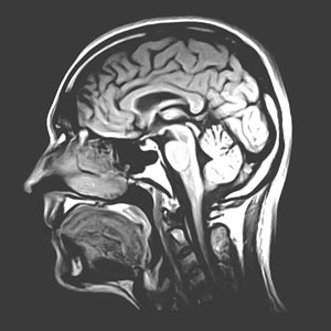 Sagittal MRI Image of Brain