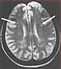 una imagen de la resonancia magntica del cerebro con las lesiones que resultan probablemente de la enfermedad