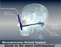 A schematic representation of a human head with an intraocular retinal prosthesis. Click on image to zoom in for more information.