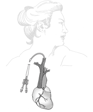 Illustration of a catheter inserted in the neck.