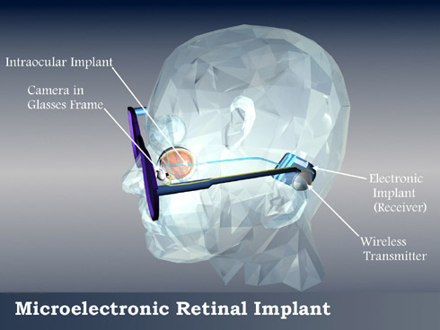 A schematic representation of a human head with an intraocular retinal prosthesis