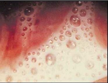 COLOR PLATE 10. Profuse purulent frothy vaginal discharge due to trichomonas (Holmes, 1999; Plate 21; reprinted with permission from McGraw Hill.)