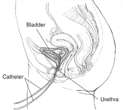 Illustration showing a catheter inserted into the bladder