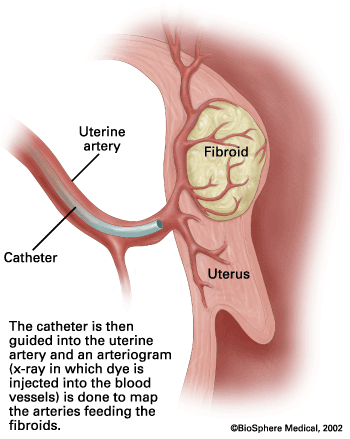 The catheter is then guided into the uterine artery and an arteriogram (x-ray in which dye is injected into the blood vessels) is done to map the arteries feeding the fibroids. 