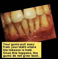 Photo: Illed gums; Text: Your gums pull away from your teeth where the tobacco is held. Once this happens, the gums do not grow back.