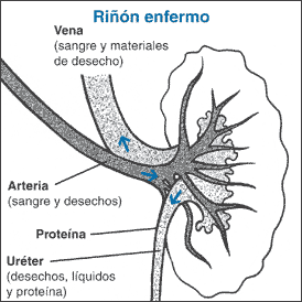 Imagen mostrando un rin que esta goteando protena .