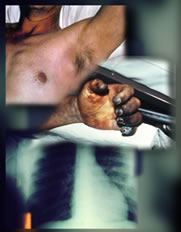 Montage of axillary bubo, septicemic hand and infected lungs.
