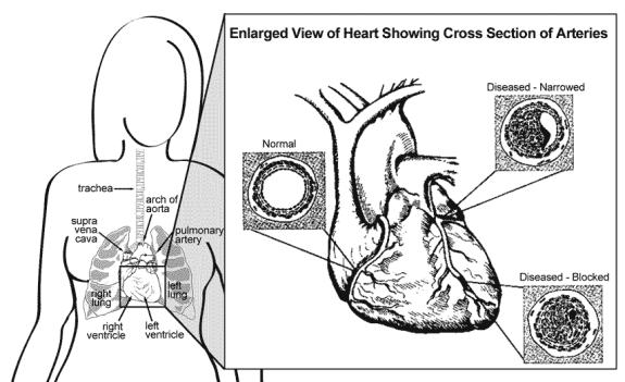 Enlarged view of heart showing cross-section of arteries