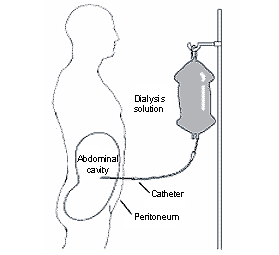 Patient receiving continuous ambulatory peritoneal dialysis (CAPD).