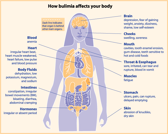Diagram of the effects of bulimia on the body
