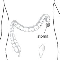 Stoma is attached to the healthy intestine.